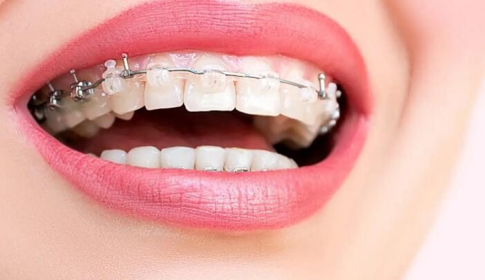 牙齒矯正費用報你知，看你適合哪種牙齒矯正療程