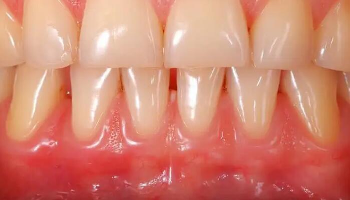 牙周病早期症狀：牙齦紅腫
