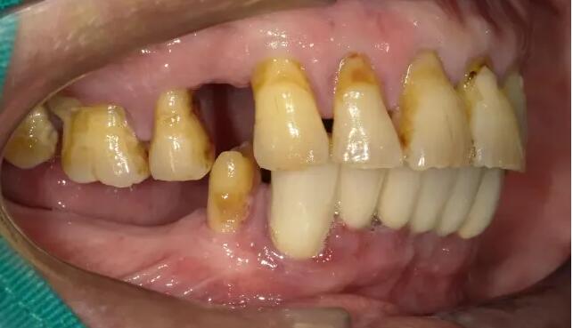 牙周病重度症狀：牙齒咬合無力
