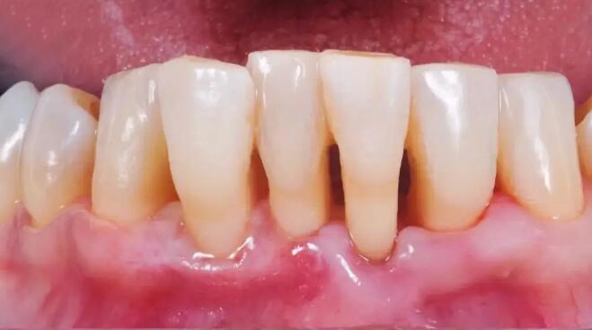 牙周病7個常見症狀