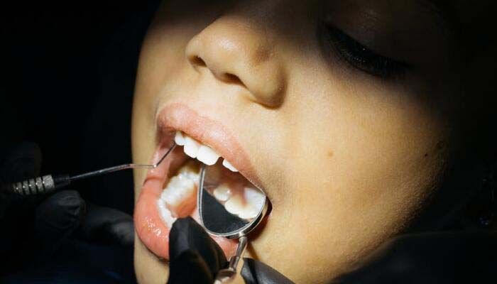 牙齒表面黑黑的如何治療？牙齒變黑原因詳解