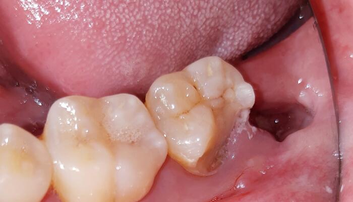 第二大臼齒缺牙不補可以嗎？