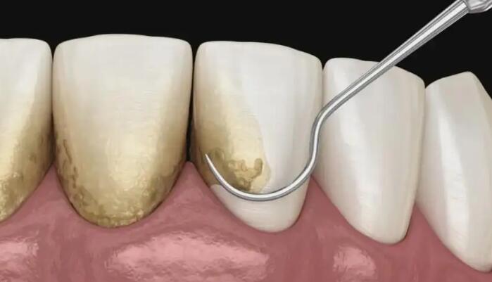 牙周病治療過程，牙周病治療費用揭秘