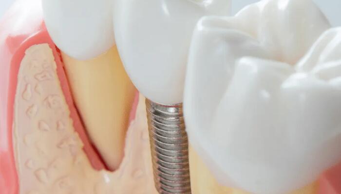 植牙補骨粉過程詳解，補骨粉相關問題