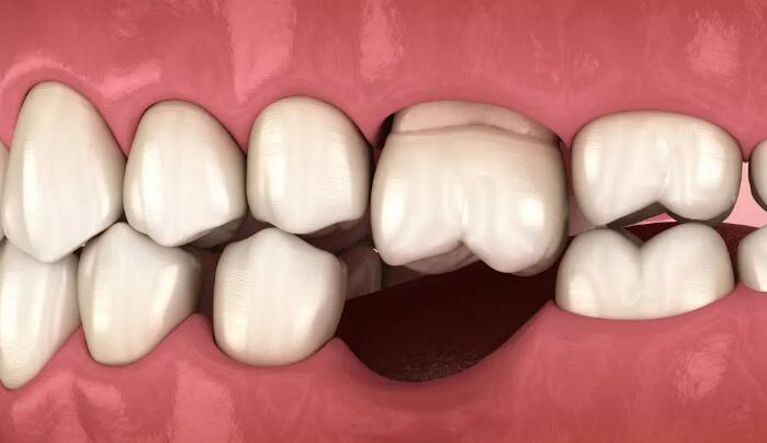 牙齒常見疾病