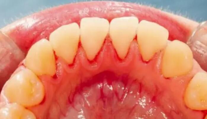 牙齦出血的病症