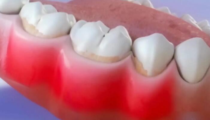 老年人如何預防和控制牙周炎