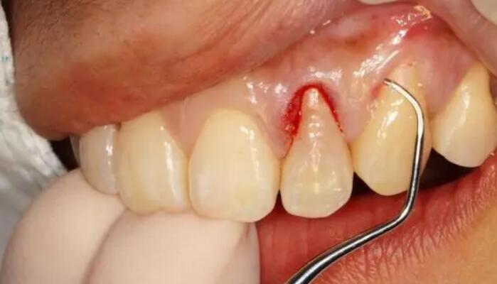 牙周炎的局部治療