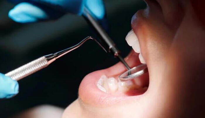 牙結石成分是什麼？