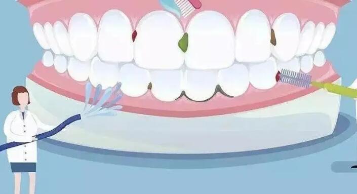牙結石清除術