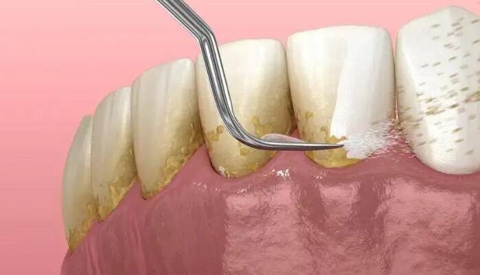 牙結石的分度