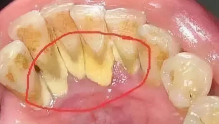牙結石形成的原因