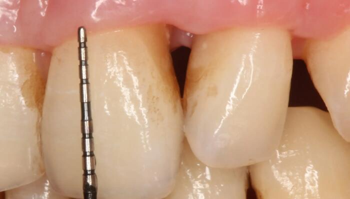 牙齦萎縮鑒別分析