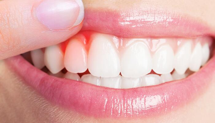 牙齦萎縮怎麼辦？牙齦萎縮補救治療方法