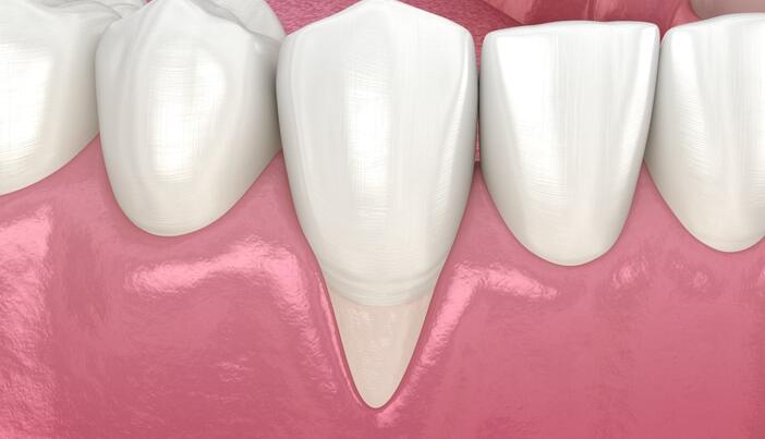 牙齦萎縮的幾種原因