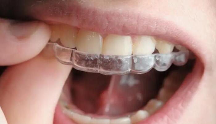 牙齒維持器平時應該怎麼清潔