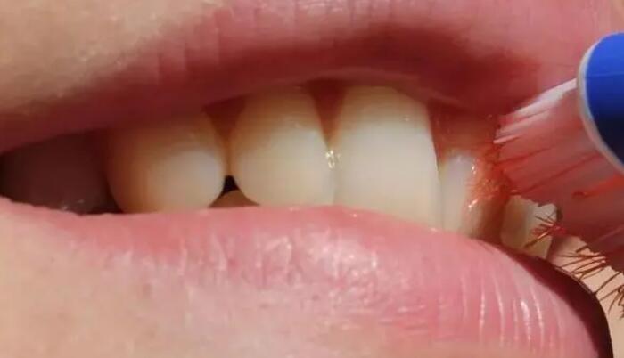 牙齦腫痛