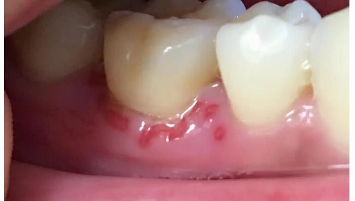 牙齦腫脹症狀