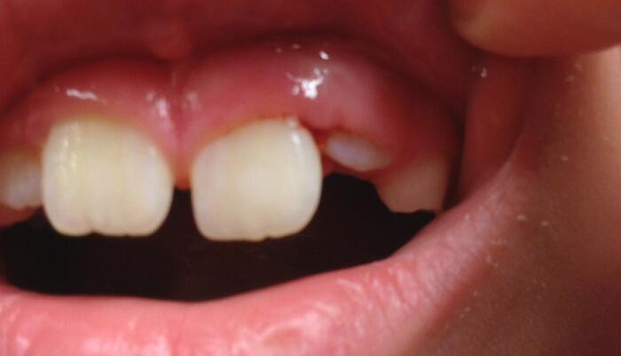 恆牙長牙萌發順序是怎樣的？