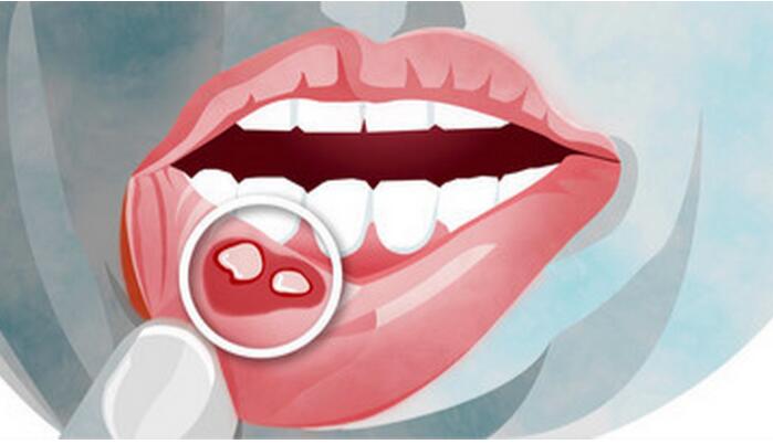 口腔潰瘍白色是怎麼回事？