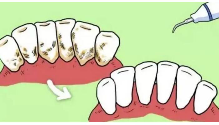 牙齦萎縮初期症狀及治療