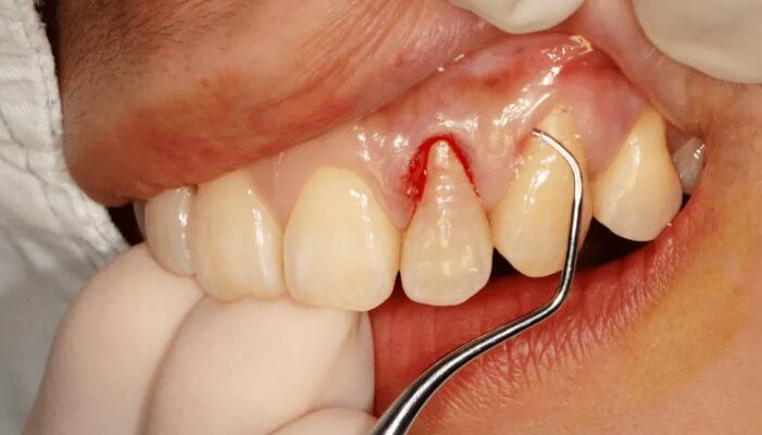 牙周袋是什麼？牙周袋如何治療？