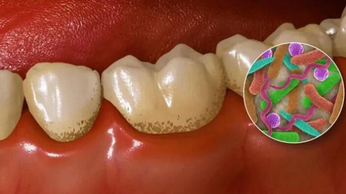 牙菌斑是什麼？牙菌斑長怎樣？