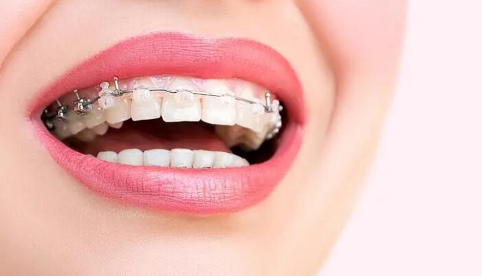 牙齒矯正原理是什麽？