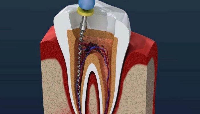 牙齒抽神經要多久？